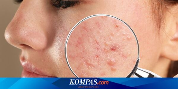 10 Cara Menghilangkan Bekas Jerawat Hitam dengan Cepat