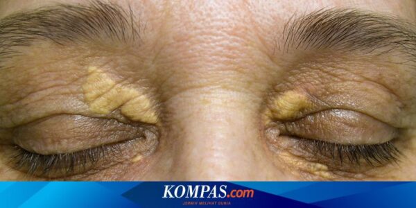 Kenali Apa Itu Xanthelasma yang Bisa Jadi Tanda Kolesterol Tinggi