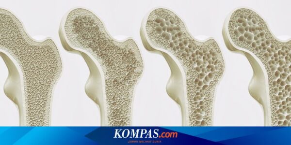 Osteoporosis