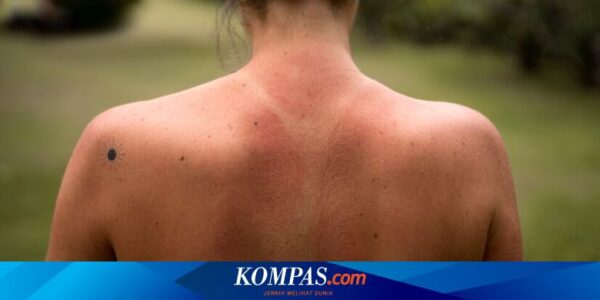 7 Tips Meredakan Sunburn dan Cara Mencegahnya