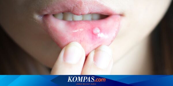 Cara Mengobati Sariawan di Bibir dengan Cepat dan Alami