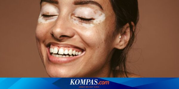 Cara Perawatan Vitiligo, Termasuk Pakai Sunscreen