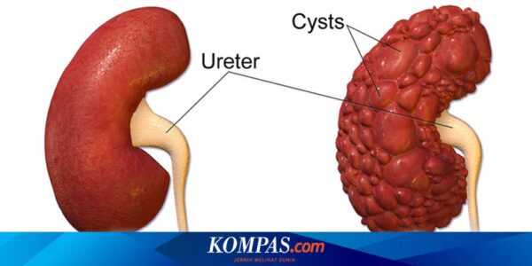 7 Cara Mencegah Komplikasi Penyakit Ginjal Polikistik