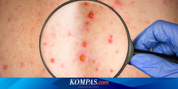 Afrika Bersiap Umumkan Status Mpox Jadi Darurat Benua