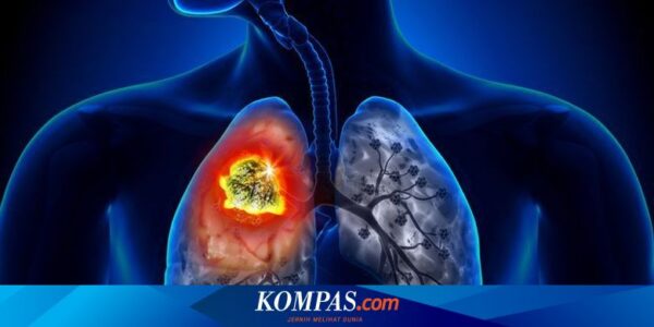 Apa Ciri-ciri Kanker Paru-paru? Berikut Penjelasan Dokter