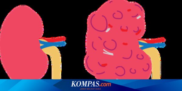 Gagal Organ Bisa Jadi Komplikasi Penyakit Ginjal Polikistik