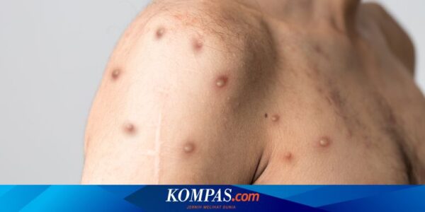 Kasus Mpox Melonjak, WHO Segera Gelar Rapat Komite Darurat