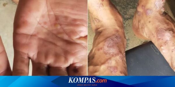 Kasus Mpox di Afrika Melonjak, CDC Siapkan 200.000 Dosis Vaksin