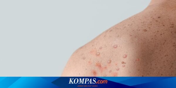 WHO: Wabah Mpox di Afrika Tengah Bisa Dihentikan, Perlu Dana Rp 2 Triliun