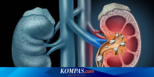 Pengobatan Atasi Batu Ginjal Berukuran Besar dan Kompleks